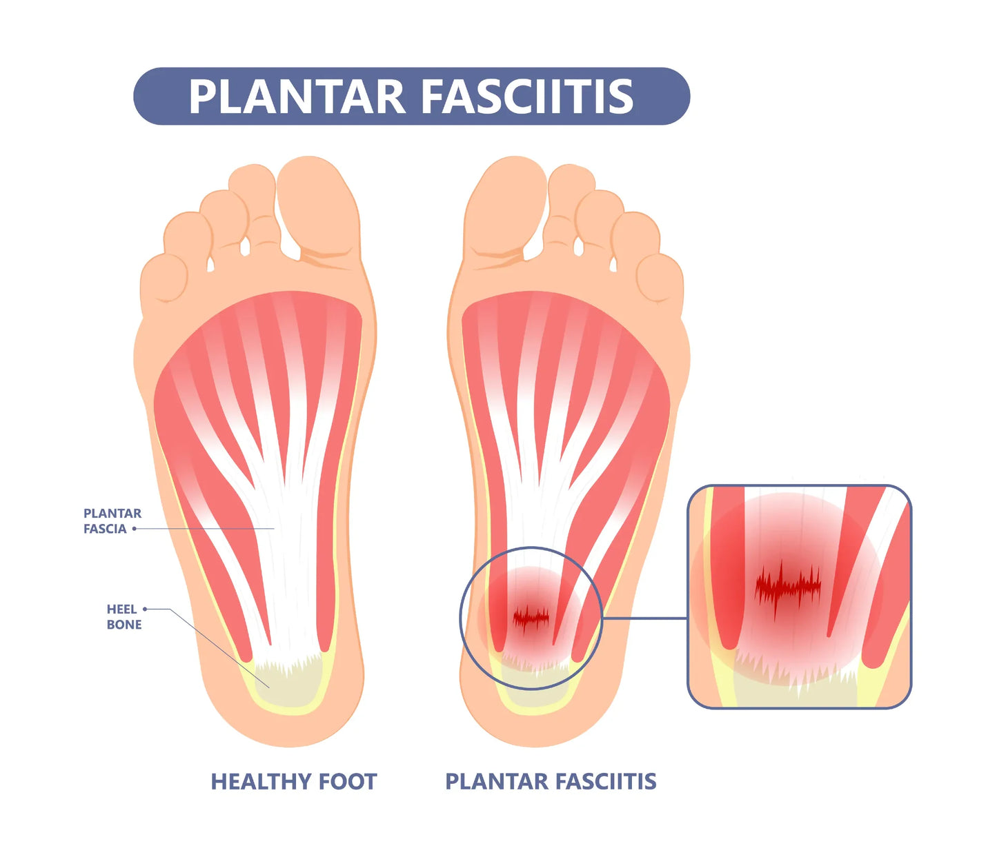 FlowFoot Triple Action Recovery Device